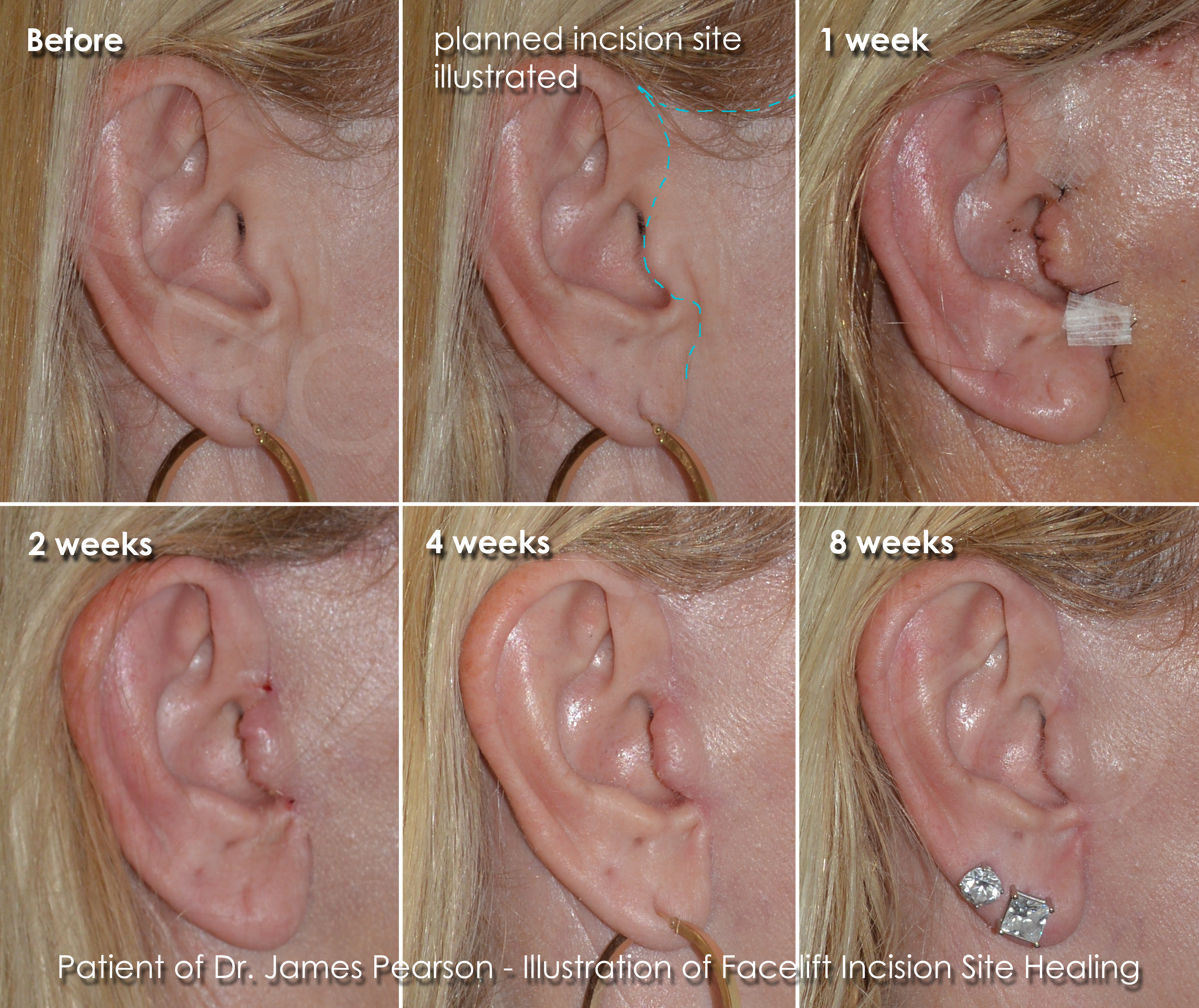 Pearson Facelift Incision